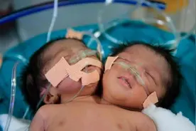 印度妈妈生下双头小宝宝，为父亲不离不弃勇敢承担点赞图片