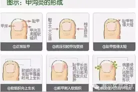 5块钱治好甲沟炎图片