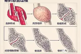 病人骨折后的饮食调养具体有哪些？图片