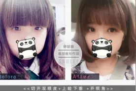 术后双眼皮如何快速恢复自然?图片