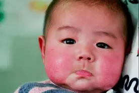 宝宝长奶癣用什么药膏，婴儿小孩湿疹一招见效！图片