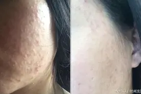 粉刺不是病，顽固真要命，误区那么多，就是弄不净！图片