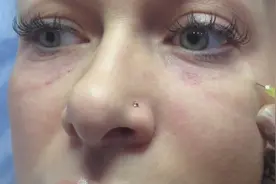 美女阿姨眼袋下垂，打几针胶原蛋白后，瞬间皮肤变嫩了视频封面