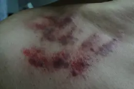 几乎失传的揪痧法能治疗很多病图片