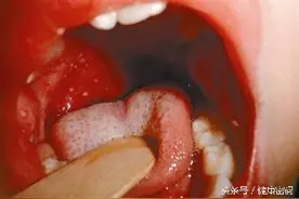 口腔破了一个洞，真的是上火导致的么？这种情况立即就医！图片