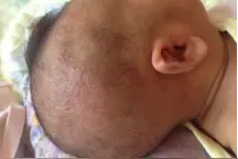 宝宝湿疹需要注意什么吗？儿童小儿湿疹如何治疗？图片