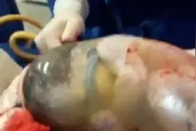 宝宝出生后海被包裹在膜里，还好发育很正常图片