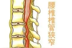 关于腰椎管狭窄怎么样治疗的措施有几种图片