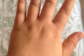 孕35周+1，每天手酸疼胀麻，肿胀，妊娠纹，真心伤不起啊！图片