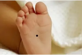 警惕：孩子身上的痣不要随便乱点，乱点会出现这些状况就不好了图片