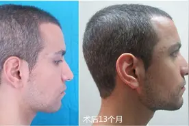 头睡扁了，还能圆回来吗？图片