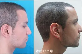头睡扁了，还能圆回来吗？图片