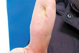 80多岁的婆婆为吃零食  大拇指被硬壳刺伤溃疡，要截肢图片