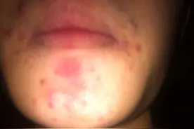 牙膏也可以祛痘？你相信么？别逗了图片