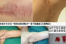 患者慎重考虑接受腋臭手术，但术后的疤痕问题你有考虑过吗图片