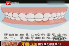 牙龈出血 因为缺乏维生素C？视频封面
