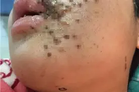 恐怖！这些玩具让13岁姑娘变“筛子脸”图片