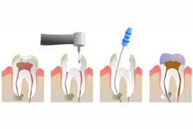 牙医帮你解答，抽“牙神经”缘何那么贵图片