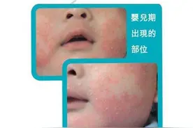 初生婴儿常见的皮肤问题图片
