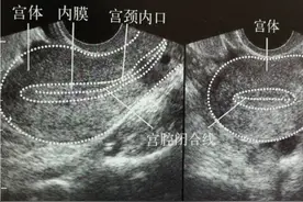 经期第13天内膜6mm，较大卵泡15*14是否正常？图片