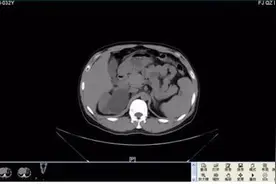 男子腰酸背痛检查发现有4个肾 发病率约十万分之一图片