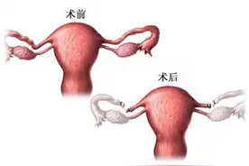 女性结扎手术全过程（附图）图片