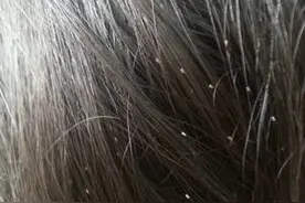 幼儿园日托    妈妈忽然发现女孩黑发里有小白粒图片