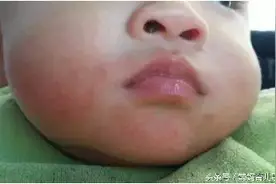 宝宝流口水后下巴发红的原因及应对措施图片