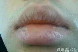 中医说唇炎。图片