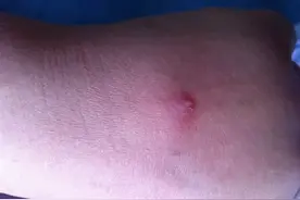 连续静滴硫酸镁    感染？静脉炎？还是药物外渗？图片