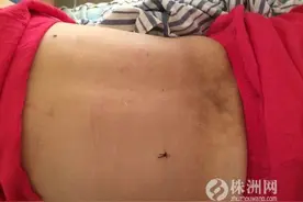 女子腹部疼伸不起腰，检查发现椎间盘“跑”出来了图片
