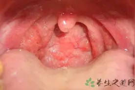 白喉是传染病吗图片