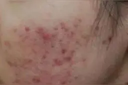所有你们想知道的痘痘肌问题，都在这里图片