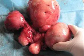 子宫肌瘤是最常见的妇科肿瘤之一严重的甚至发生恶变，危及生命!图片