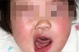 南通通州一18个月大幼儿突然面瘫 因空调风直吹所致图片