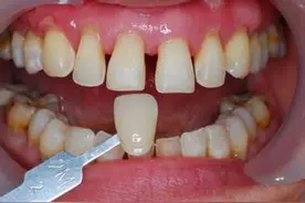 牙齿贴面有毒性？牙医：谨慎使用图片