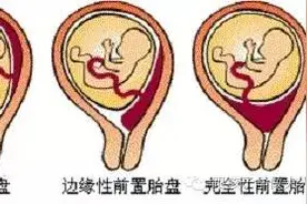 整个孕期医生经常对你说的几个医学名词，作为孕妈你最好要懂！图片