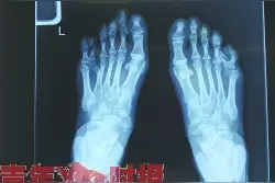 双脚各多长了根脚趾 她从不敢穿凉鞋图片