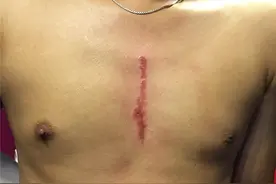 儿子术后胸口留疤　父亲文同样的疤陪伴图片