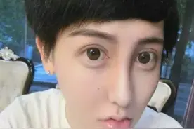 ”蛇精男“刘梓晨生病住院，是因被喷过度，还是整容后遗症复发？图片