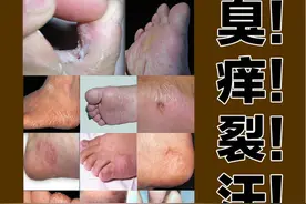 “香港脚”真的折磨人，止痒除臭有妙招！图片