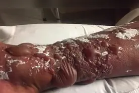 老太杀鱼被刺伤，全身竟多器官衰竭！图片