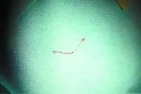 广州10岁男孩长“虫牙” 家长放青蛙入嘴抓虫！图片