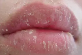 反反复复的唇炎，痛痒难忍，一个小药片就能帮你解决！图片