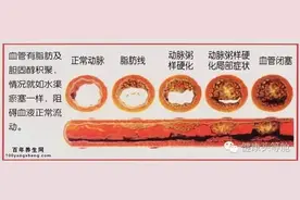 生鲜蔬果汁健康小百科之动脉硬化图片