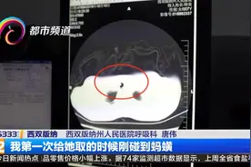 咳嗽吐血十多天 原来是蚂蟥作祟！视频封面