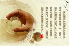 “康复神器”：中医拔罐知多少图片