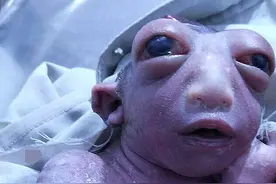 印妇女产畸形儿似外星人 半个脑袋眼球突出图片