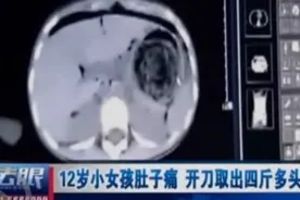 12岁小女孩肚子疼,开刀取出四斤多头发视频封面