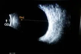 眼前黑影来回飘动 警惕“飞蚊症”图片